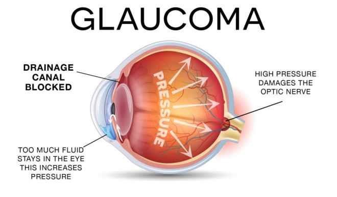 Glaucoma more prevalent in black race – Association