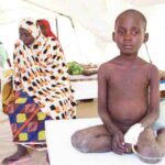 n A child from Muna Camp undergoing treatment at MSF’s Cholera Treatment Unit in Dala, Maiduguri. Children, especially if they are undernourished, are at a greater risk of death, if infected by cholera.
