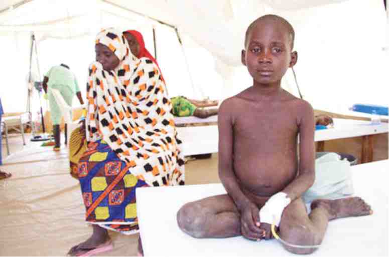 n A child from Muna Camp undergoing treatment at MSF’s Cholera Treatment Unit in Dala, Maiduguri. Children, especially if they are undernourished, are at a greater risk of death, if infected by cholera.