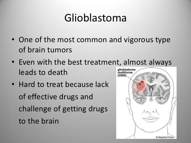 What Is Glioblastoma Daily Trust