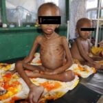 malnourished-children1