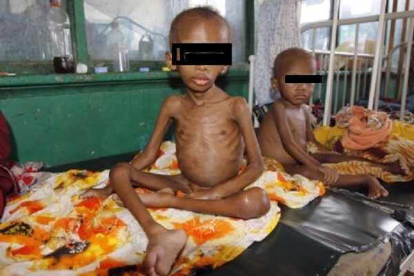 malnourished-children1