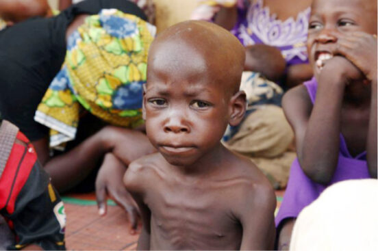 Malnutrition: Still a growing menace
