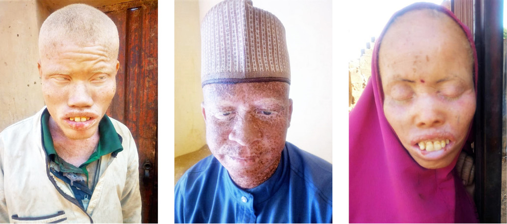 Save us from skin cancer, albinos cry to Buhari