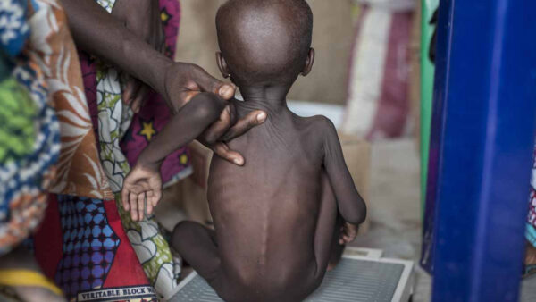Severe Acute Malnutrition of nigeria