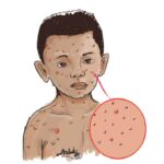 How to protect yourself from chicken pox