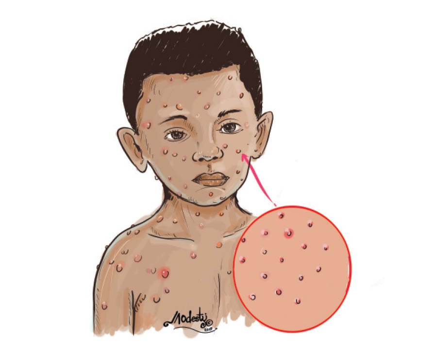 How to protect yourself from chicken pox