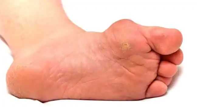 I am suffering from diabetic foot