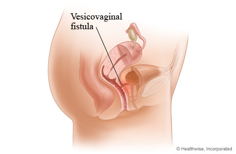 800,000 Nigerian women live with fistula – UNFPA