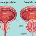 Why you should know about prostate cancer