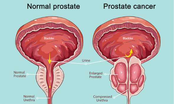 Medical experts caution on lifestyle, foods to check prostate cancer