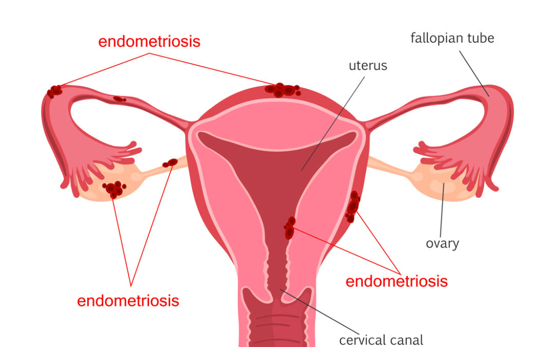 Tall Slim Girls Likely To Develop Endometriosis — Guardian Life — The  Guardian Nigeria News – Nigeria and World News