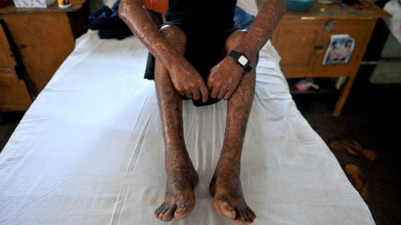 Leprosy: FG tasked on life-saving drugs for over 3,000 patients