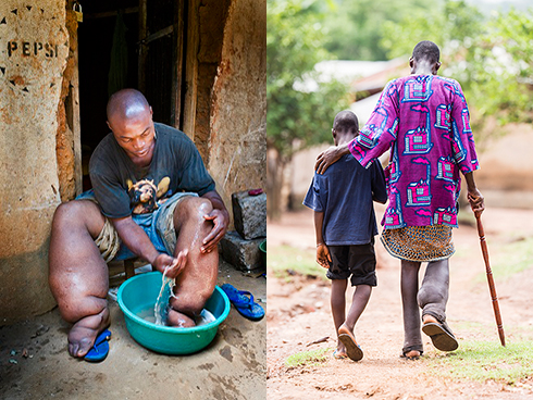 Two out of every three Nigerians are at risk of Neglected Tropical Diseases – Dr Chukwuma Anyaike