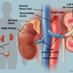 20m Nigerians battle kidney disease, expensive treatment