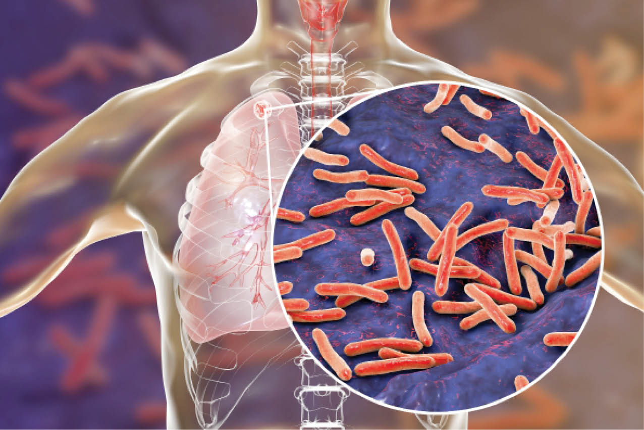 How tuberculosis reshaped our immune systems