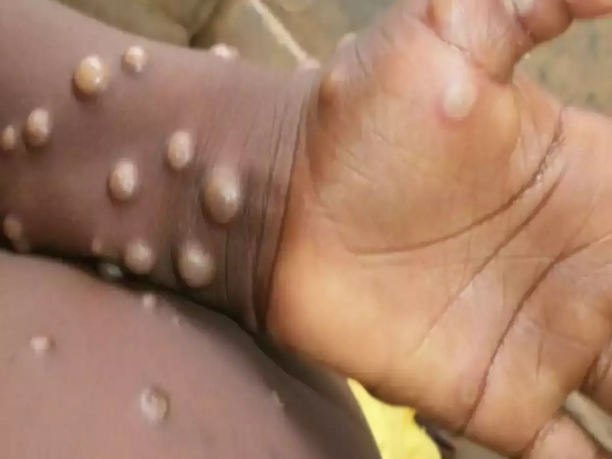 Tips on monkeypox