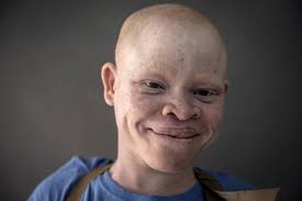 Albinos want FG to revive free cancer treatment