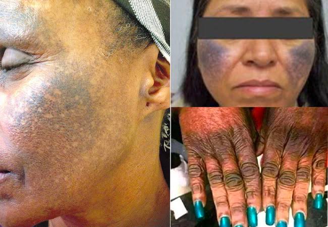 Six harms bleaching does to your skin, health - Daily Trust