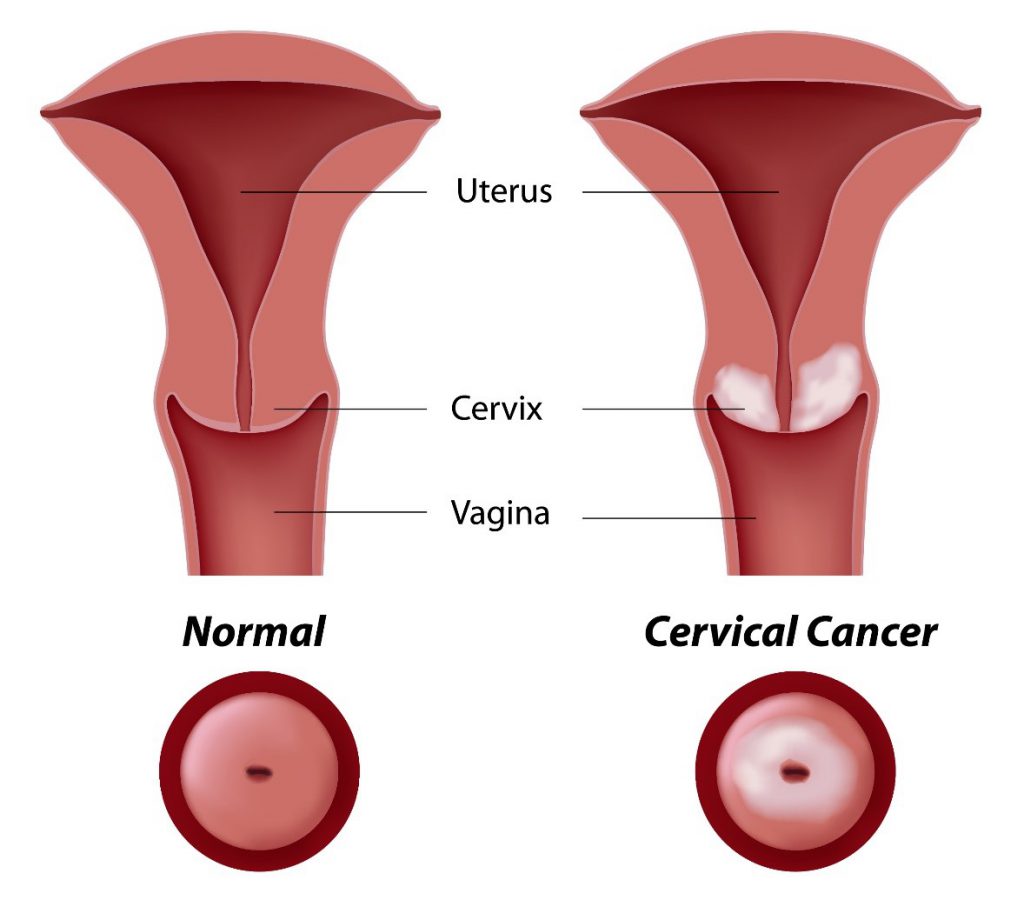 What To Know About Cervical Cancer Daily Trust