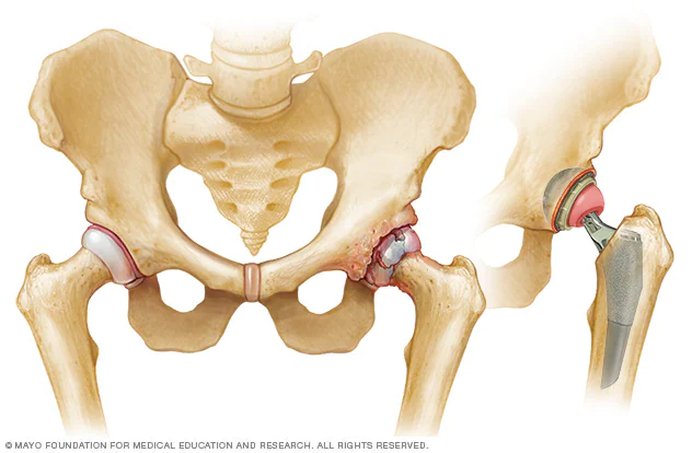 Study finds Adult Stem Cell Therapy effective alternative to total hip replacement