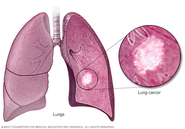 Medical expert frowns at low reporting of lung cancer in Nigeria, sub-Saharan Africa