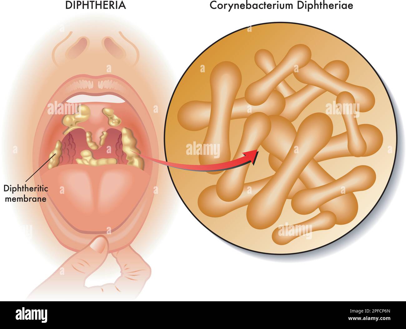 diphtheria pseudomembrane