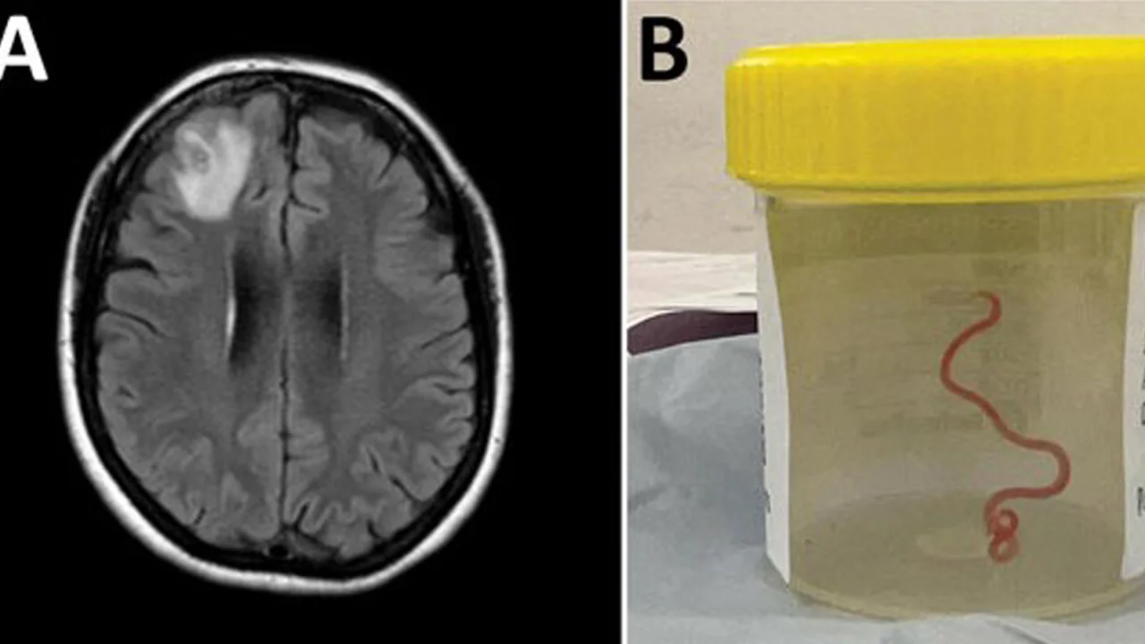 Doctors remove 3-inch parasitic worm from woman’s brain in world’s first case