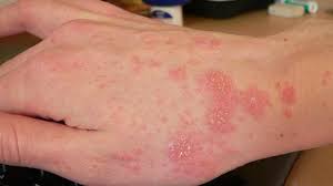 51 inmates infected with scabies at Adamawa Correctional Centre