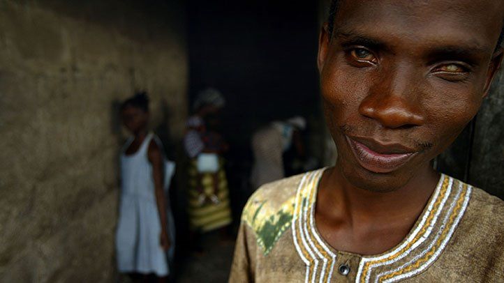 5m people at risk of river blindness, other diseases in Kaduna